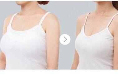 成都濟慈德美醫(yī)療美容門診部巨乳縮小