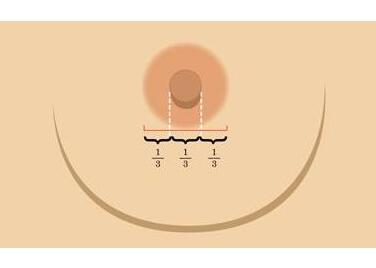 成都紐萊茵醫(yī)療美容門診部乳頭內(nèi)陷矯正