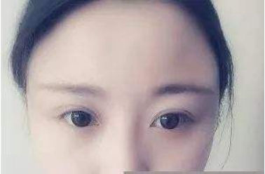 海南華美醫(yī)學美容醫(yī)院自體脂肪豐太陽穴