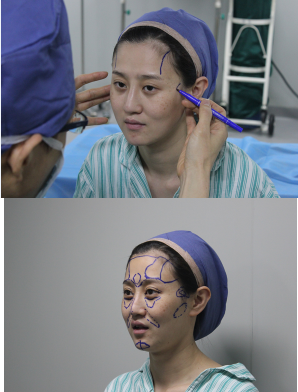 上海時光整形醫(yī)院自體脂肪填充臉部真實效果圖分享