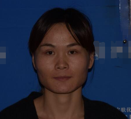 上海時光整形醫(yī)生何晉龍做下頜角磨骨術(shù)前術(shù)后案例效果對比圖