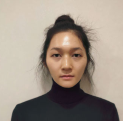 上海時(shí)光整形醫(yī)院做面部玻尿酸注射效果怎么樣？