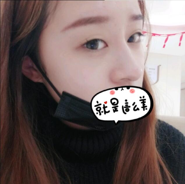 上海時光整形做玻尿酸注射隆鼻效果怎么樣？附陳文慧醫(yī)生真實案例對比圖