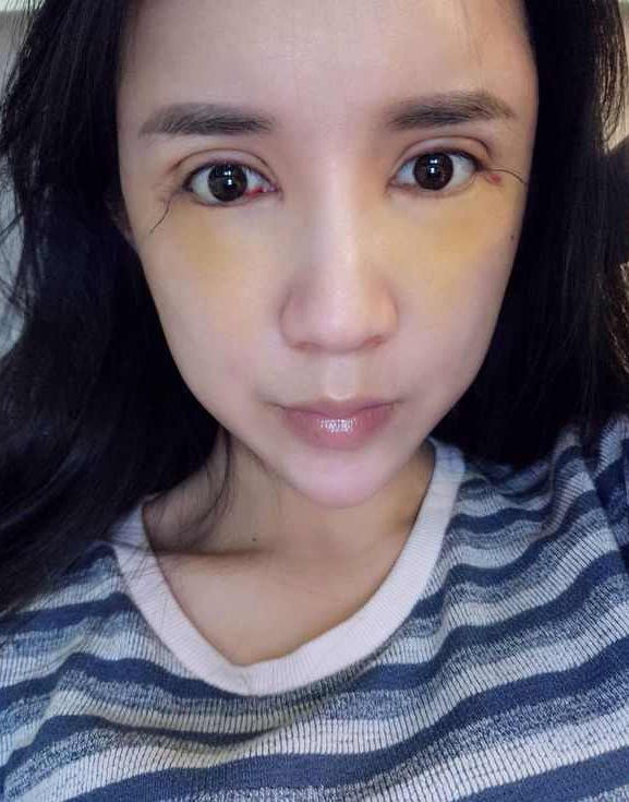 上海時(shí)光整形醫(yī)院張晶醫(yī)生做開眼角怎么樣？附真實(shí)效果圖