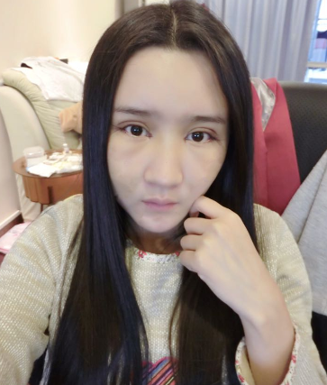 上海時光整形醫(yī)院自體脂肪填充臉部真實效果圖分享