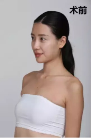 上海時(shí)光整形醫(yī)院何晉龍醫(yī)生做假體隆胸怎么樣？附案例對(duì)比圖