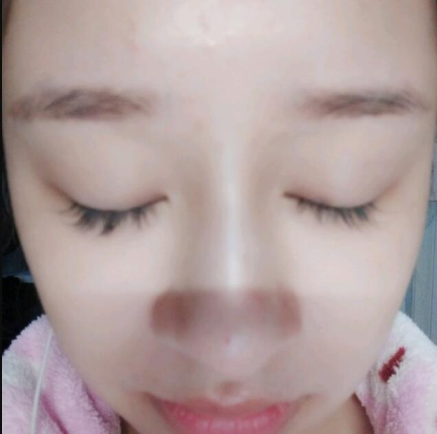 上海時(shí)光整形做玻尿酸注射隆鼻效果怎么樣？附陳文慧醫(yī)生真實(shí)案例對(duì)比圖