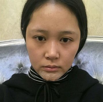 上海時光整形醫(yī)院做豐下巴怎么樣？許黎平醫(yī)生豐下巴案例分享