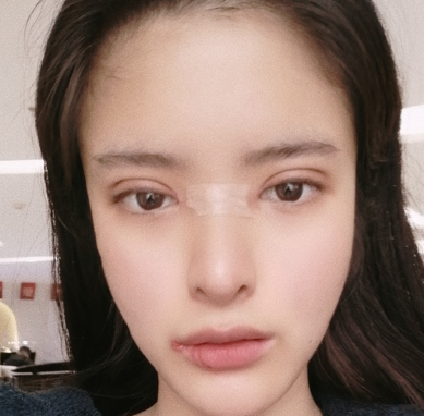 合肥韓美整形醫(yī)院做雙眼皮+開眼角效果怎么樣?附石顯武醫(yī)生真實案例效果圖