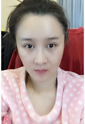 上海時光整形醫(yī)院自體脂肪填充臉部真實效果圖分享