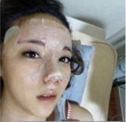 上海時(shí)光整形醫(yī)生何晉龍做假體隆鼻效果怎么樣？附案例效果對(duì)比圖