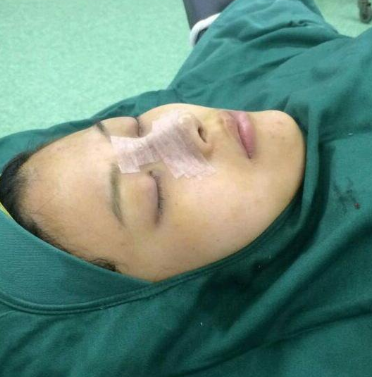 合肥韓美整形醫(yī)院做隆鼻手術(shù)效果怎么樣?附劉冷醫(yī)生隆鼻案例效果圖