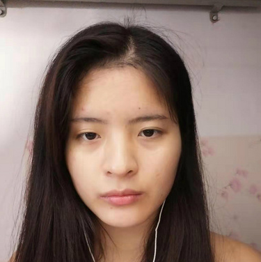 合肥韓美整形醫(yī)院做雙眼皮+開眼角效果怎么樣?附石顯武醫(yī)生真實案例效果圖