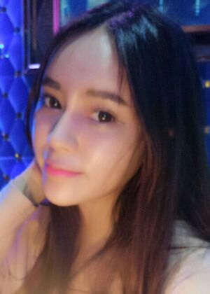 鞍山王景醫(yī)療美容外科診所做自體脂肪豐蘋果肌效果怎么樣？附張婉鸝案例效果圖