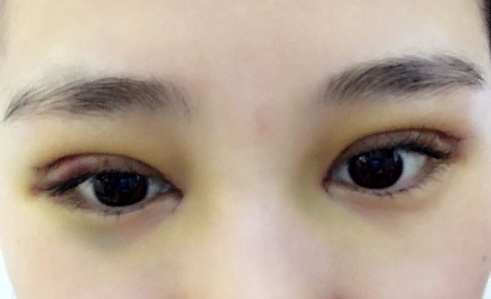 蚌埠韓美美萊整形醫(yī)生鄭捷做開眼角怎么樣？附案例效果圖