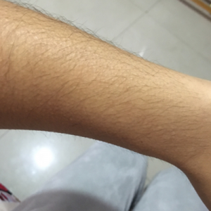 蚌埠市第三人民醫(yī)院燒傷整形科李勇醫(yī)生做手臂激光脫毛案例效果圖 蚌埠市第三人民醫(yī)院燒傷整形科李勇醫(yī)生做手臂激光脫毛案例效果圖