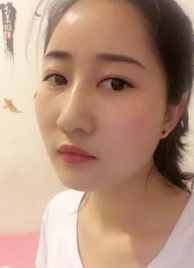 鞍山菲之都整形醫(yī)生李宗亮做字體脂肪豐太陽穴效果怎么樣？附案例效果對比圖