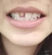 鞍山時(shí)代口腔門(mén)診部劉昕醫(yī)生做美容冠效果怎么樣？一起來(lái)看看吧