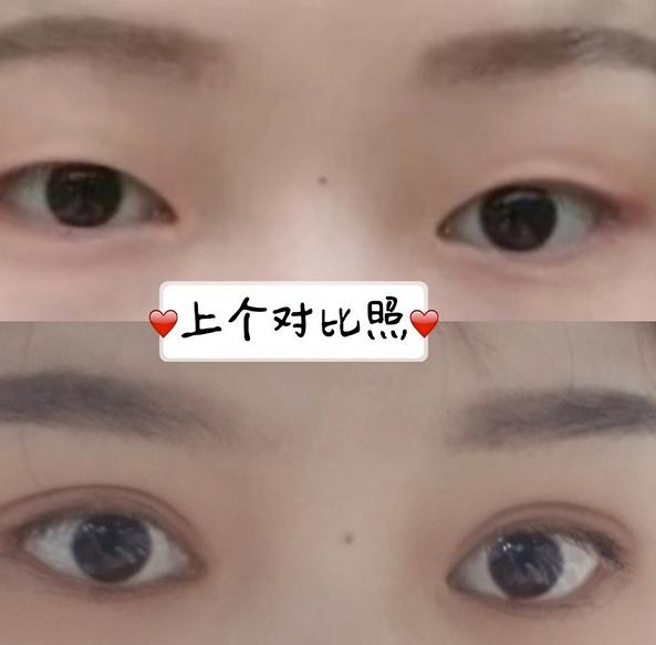鞍山菲之都醫(yī)療整形醫(yī)院做開眼角+全切雙眼皮效果怎么樣？附藺嬌婷醫(yī)生案例