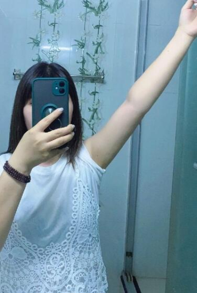 蚌埠市第三人民醫(yī)院燒傷整形科楊蔚做手臂吸脂效果對比圖 蚌埠市第三人民醫(yī)院燒傷整形科楊蔚做手臂吸脂效果對比圖