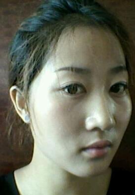 鞍山菲之都整形醫(yī)生李宗亮做字體脂肪豐太陽穴效果怎么樣？附案例效果對比圖