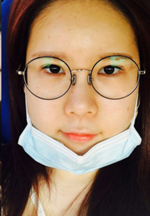 安康希顏醫(yī)療整形醫(yī)生王奇效做面部吸脂案例效果對比圖