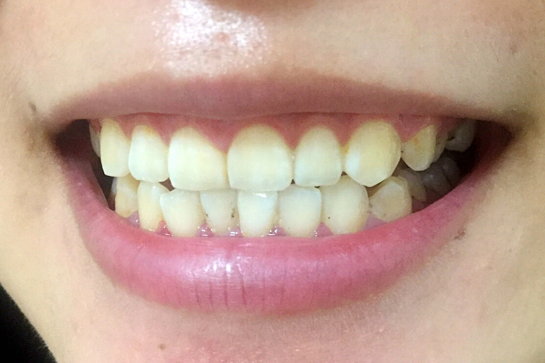 安慶渡江口腔醫(yī)院張良斌醫(yī)生做超聲波洗牙效果怎么樣？附洗牙案例效果圖