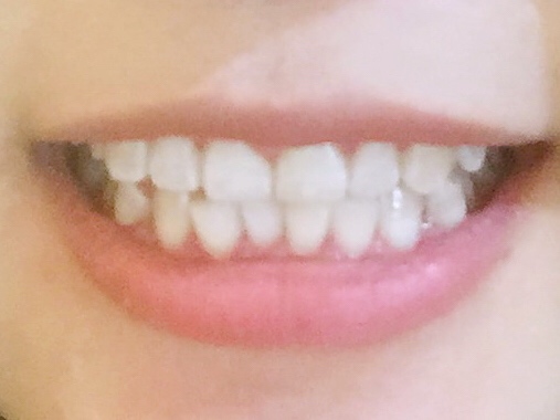 安慶渡江口腔醫(yī)院張良斌醫(yī)生做超聲波洗牙效果怎么樣？附洗牙案例效果圖