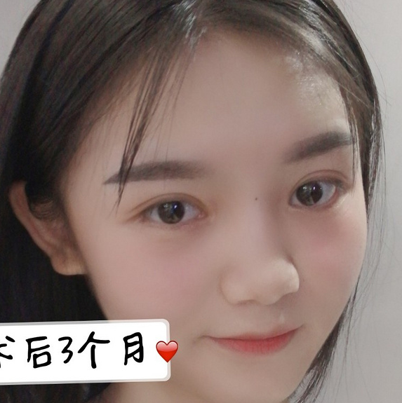 鞍山菲之都醫(yī)療整形醫(yī)院做開眼角+全切雙眼皮效果怎么樣？附藺嬌婷醫(yī)生案例