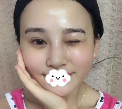 蚌埠韓美美萊整形醫(yī)生歷芳做耳軟骨隆鼻怎么樣？附耳軟骨隆鼻案例對比圖