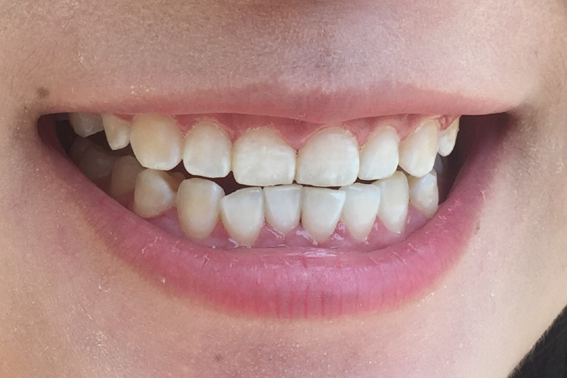 安慶渡江口腔醫(yī)院張良斌醫(yī)生做超聲波洗牙效果怎么樣？附洗牙案例效果圖