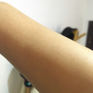 蚌埠市第三人民醫(yī)院燒傷整形科李勇醫(yī)生做手臂激光脫毛案例效果圖 蚌埠市第三人民醫(yī)院燒傷整形科李勇醫(yī)生做手臂激光脫毛案例效果圖