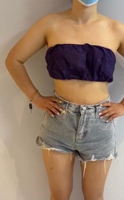 蚌埠市第三人民醫(yī)院燒傷整形科楊蔚做手臂吸脂效果對比圖 蚌埠市第三人民醫(yī)院燒傷整形科楊蔚做手臂吸脂效果對比圖