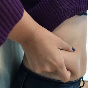 蚌埠韓美美萊整形醫(yī)生張濤做水動力吸脂怎么樣？附吸脂案例效果圖