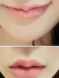巴中時(shí)光醫(yī)學(xué)美容門診部做玻尿酸豐唇效果怎么樣？附李紅強(qiáng)豐唇案例