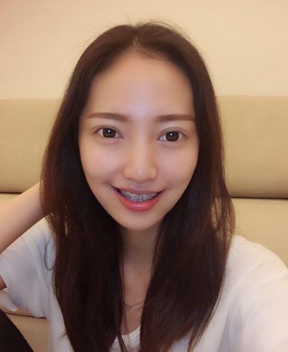 巴中華醫(yī)口腔醫(yī)院做牙齒矯正效果好嗎？附母汶靈醫(yī)生牙齒矯正案例效果圖