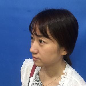 蚌埠韓美美萊整形做玻尿酸面部除皺效果怎么樣？附陳澤醫(yī)生案例效果圖