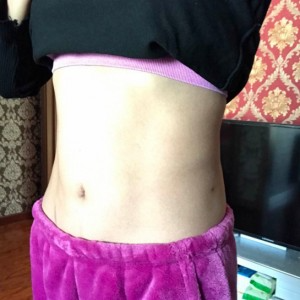 蚌埠韓美美萊整形醫(yī)生張濤做水動力吸脂怎么樣？附吸脂案例效果圖