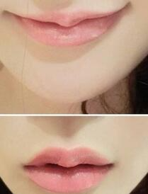 巴中時光醫(yī)學(xué)美容門診部做玻尿酸豐唇效果怎么樣？附李紅強豐唇案例