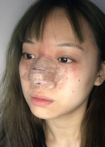 周娜醫(yī)生縮鼻頭案例效果圖