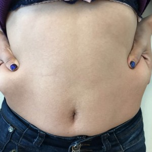 蚌埠韓美美萊整形醫(yī)生張濤做水動力吸脂怎么樣？附吸脂案例效果圖