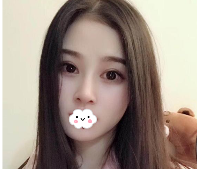 蚌埠韓美美萊整形醫(yī)生歷芳做耳軟骨隆鼻怎么樣？附耳軟骨隆鼻案例對比圖