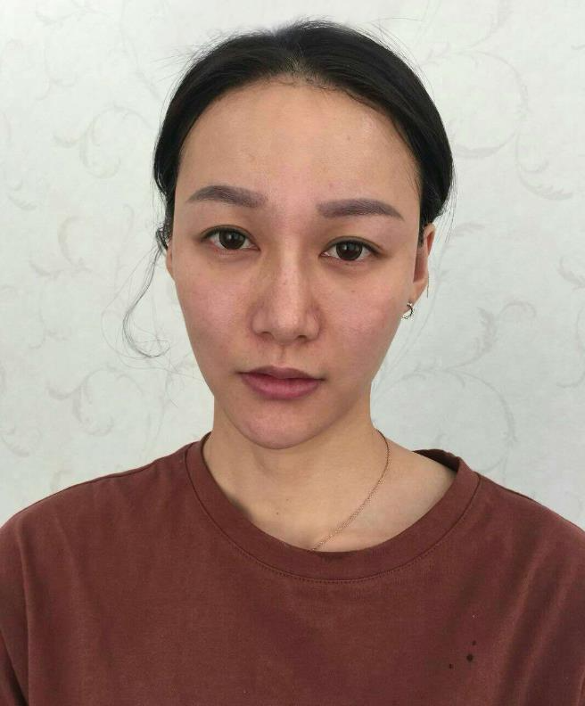 鞍山王景醫(yī)療美容外科診所做光子嫩膚怎么樣？附王景醫(yī)生案例效果圖