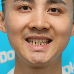 鞍山時(shí)代口腔門診部做瓷貼面怎么樣？附孫興國(guó)醫(yī)生瓷貼面案例效果圖