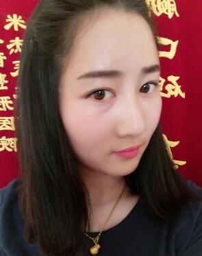 鞍山菲之都整形醫(yī)生李宗亮做字體脂肪豐太陽穴效果怎么樣？附案例效果對比圖