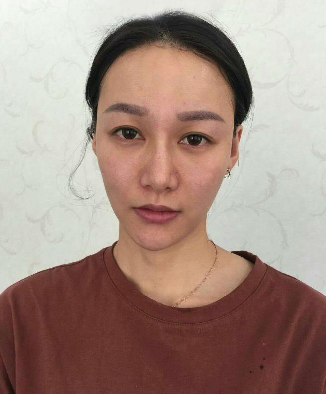 鞍山王景醫(yī)療美容外科診所做光子嫩膚怎么樣？附王景醫(yī)生案例效果圖