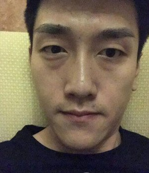 鞍山燕麗醫(yī)療美容醫(yī)院薛媚醫(yī)生做去眼袋效果怎么樣？附案例效果對比圖