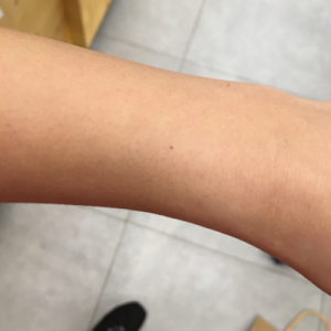 蚌埠市第三人民醫(yī)院燒傷整形科李勇醫(yī)生做手臂激光脫毛案例效果圖 蚌埠市第三人民醫(yī)院燒傷整形科李勇醫(yī)生做手臂激光脫毛案例效果圖