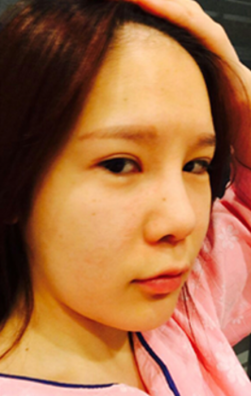 安康希顏醫(yī)療整形醫(yī)生王奇效做面部吸脂案例效果對比圖