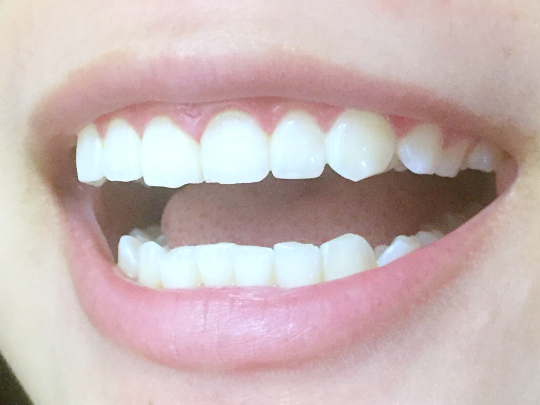 安慶渡江口腔醫(yī)院張良斌醫(yī)生做超聲波洗牙效果怎么樣？附洗牙案例效果圖